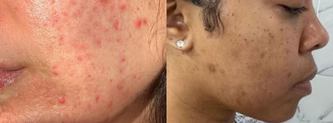 Red Spots/Acne