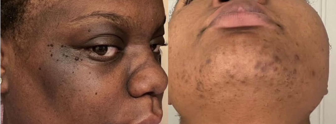 Dark Spots/Complexion