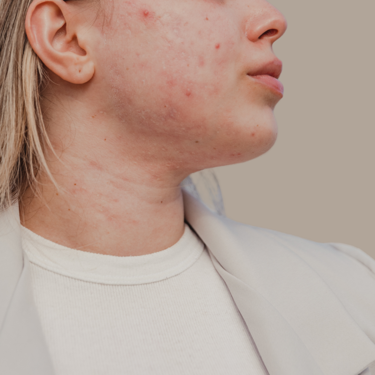 Acne & Blemishes