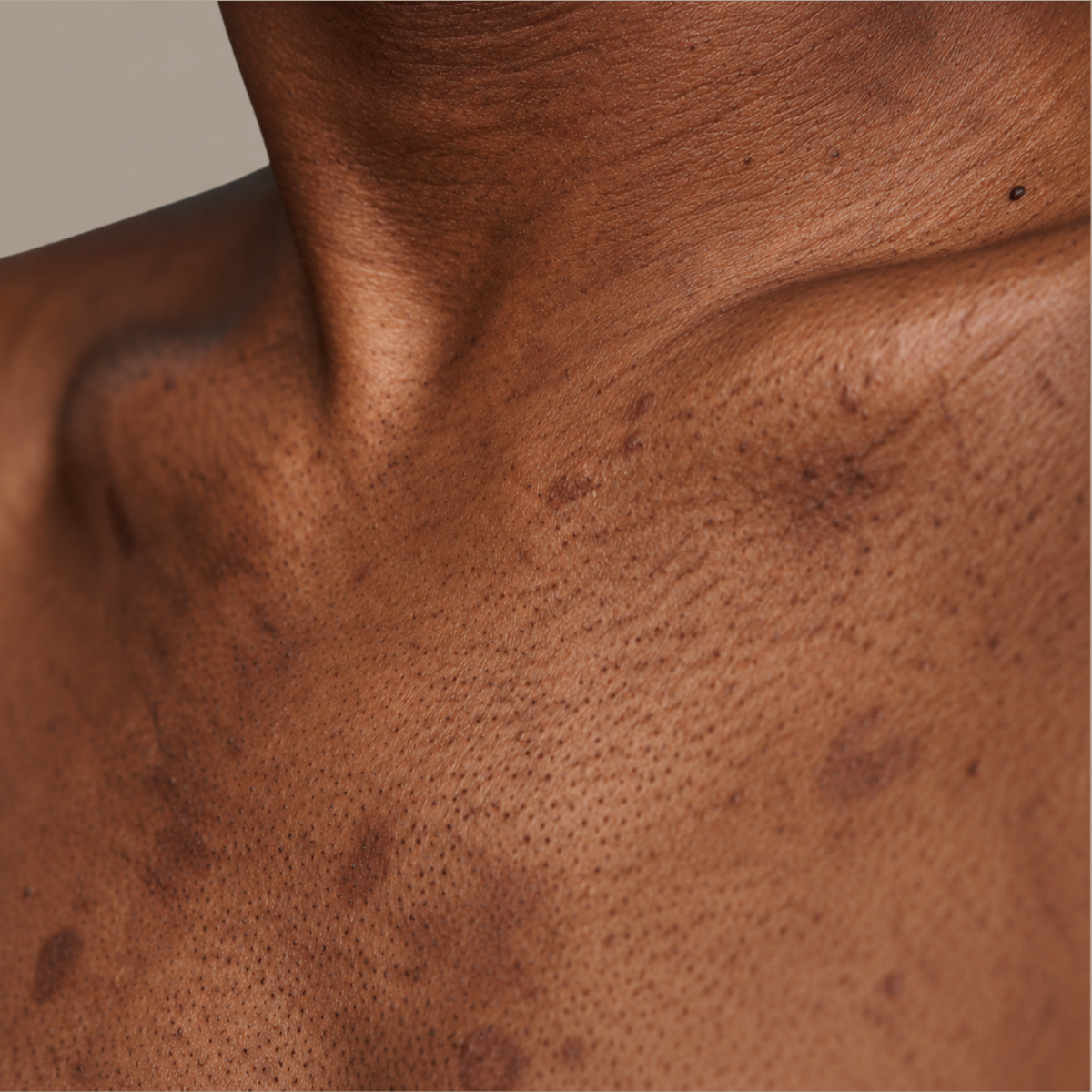 Dark Spots & Uneven Tone