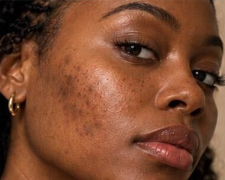 Dark Spots & Uneven Tone